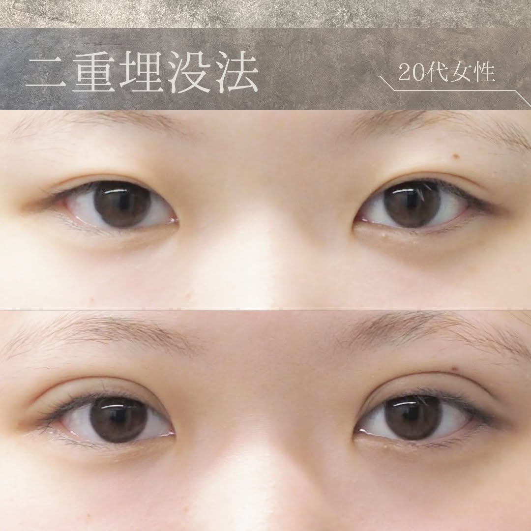 Bloom Delight Clinicの二重埋没法症例