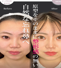 eクリニック新宿院の鼻整形