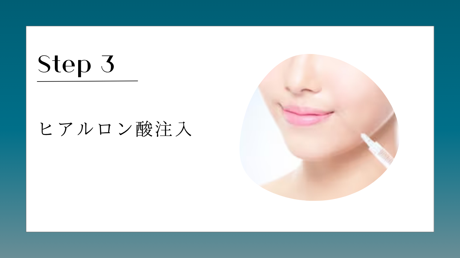 ヒアルロン酸注入