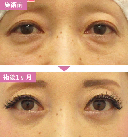 湘南美容クリニックの切らないクマ取り・たるみ取りの症例写真
