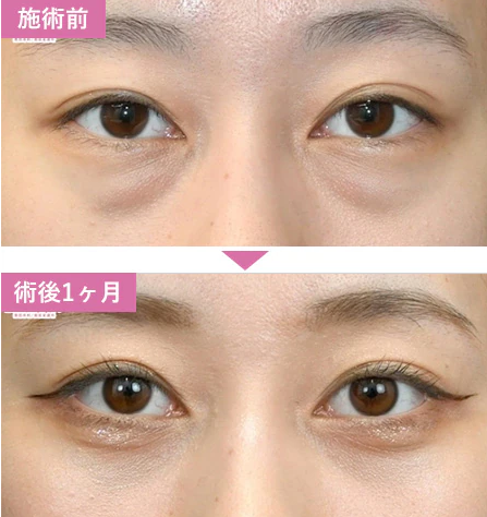 湘南美容クリニックの切らないクマ取り・たるみ取りの症例写真