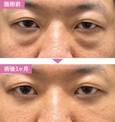 湘南美容クリニックの切らないクマ取り・たるみ取り