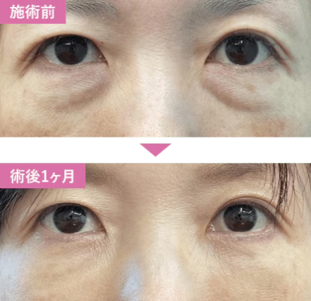 湘南美容クリニックの切らないクマ取り・たるみ取り＋脂肪注入の症例写真