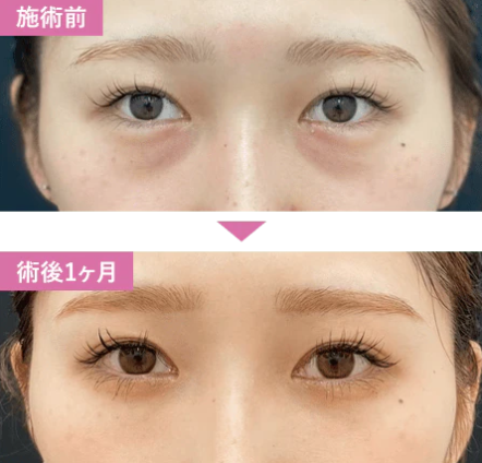 湘南美容クリニックの切らないクマ取り・たるみ取り＋脂肪注入の症例写真