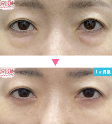湘南美容クリニックの切らないクマ取り・たるみ取り＋脂肪注入の症例写真