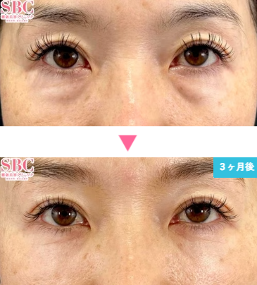 湘南美容クリニックの裏ハムラ法の症例写真