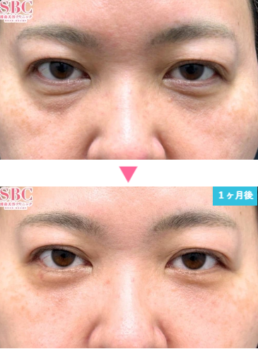 湘南美容クリニックの裏ハムラ法の症例写真