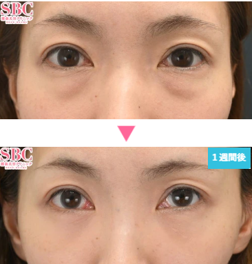 湘南美容クリニックの裏ハムラ法の症例写真