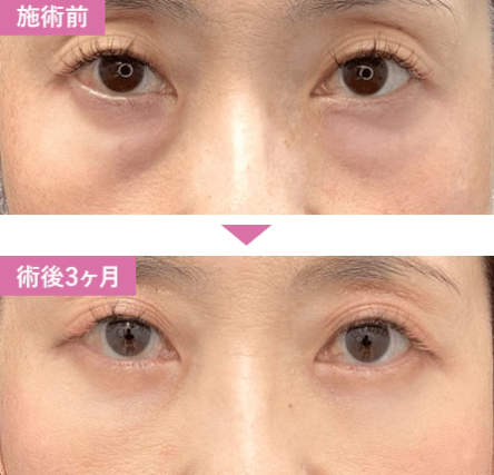 湘南美容クリニックの切開ハムラ法の症例写真