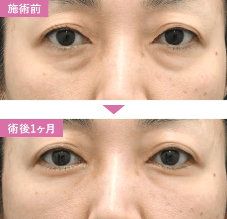 湘南美容クリニックの切開ハムラ法の症例写真