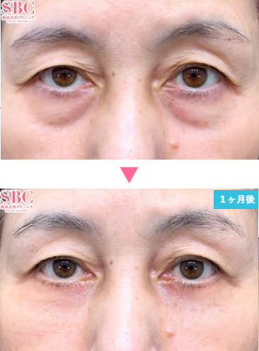 湘南美容クリニックの切開ハムラ法の症例写真