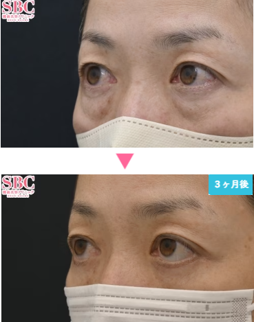 湘南美容クリニックのアイバックリムーブ法