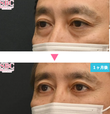 湘南美容クリニックのアイバックリムーブ法