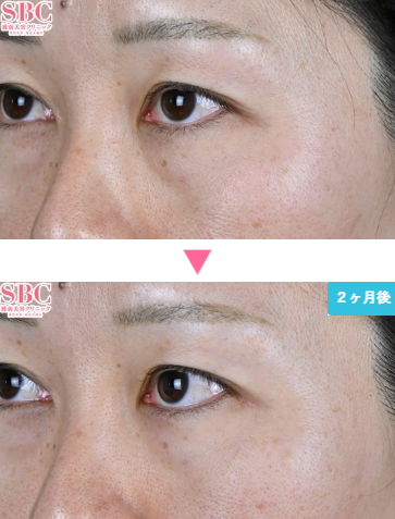 湘南美容クリニックのモフィウス8の症例写真