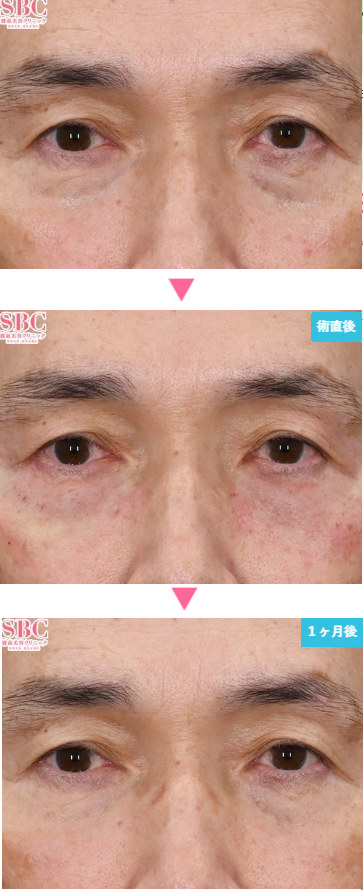 湘南美容クリニックのモフィウス8の症例写真