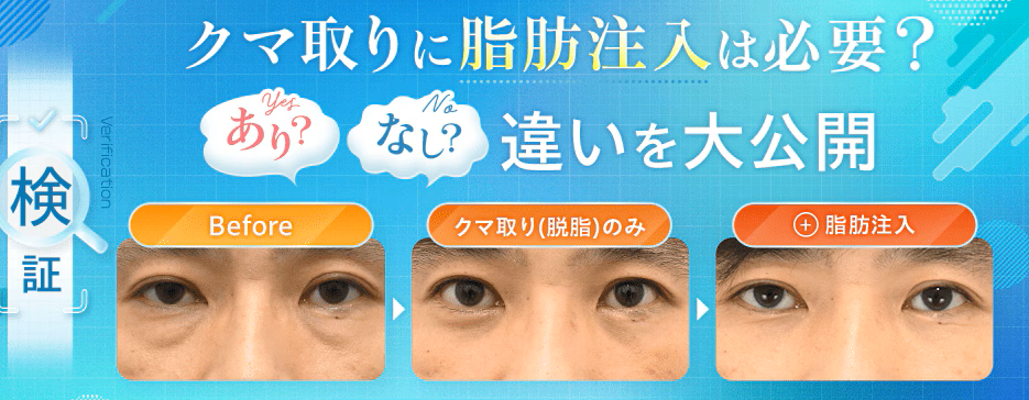 湘南美容クリニックの切らないクマ取り＋脂肪注入