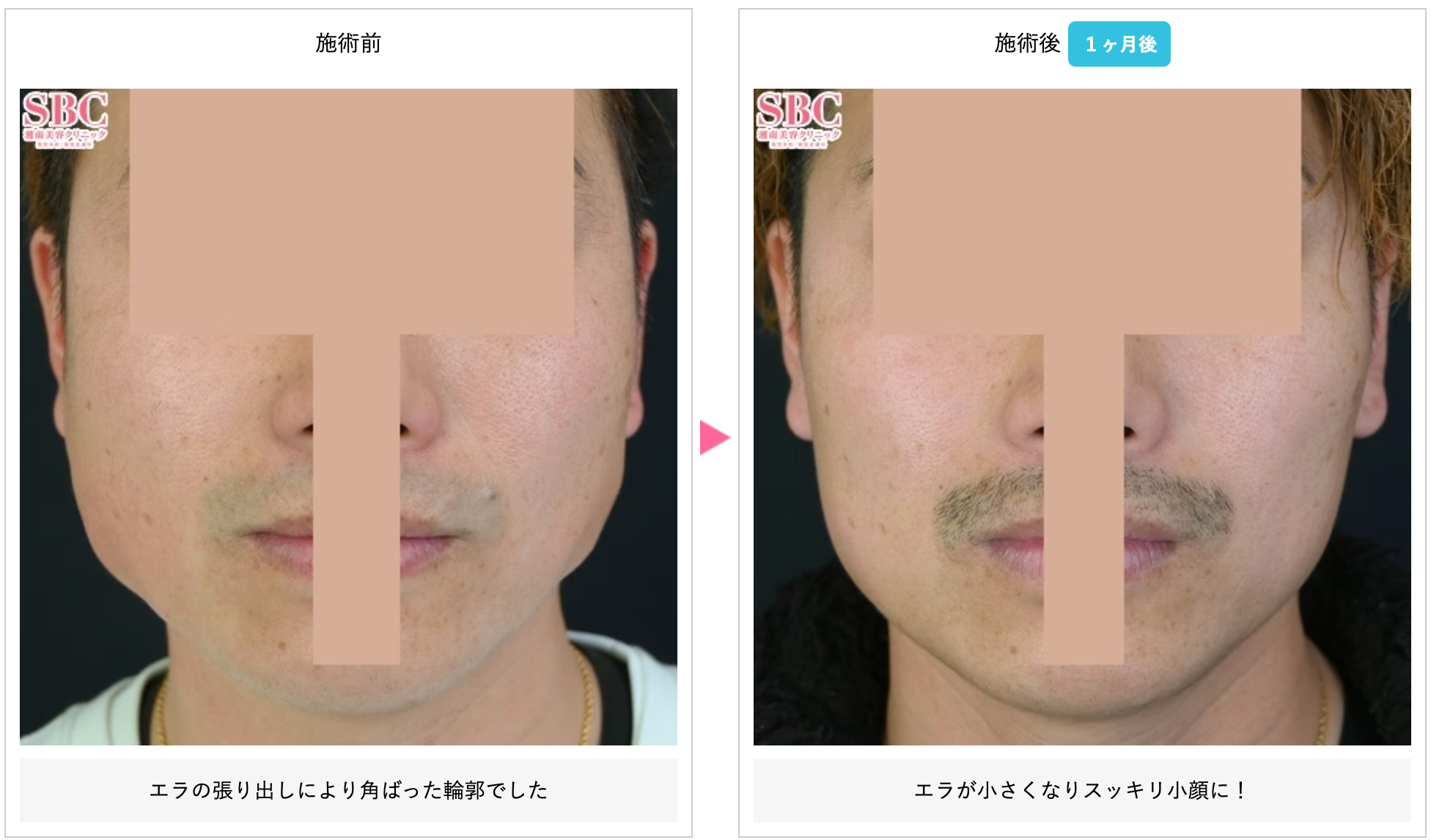 湘南美容クリニックのエラボトックス症例写真