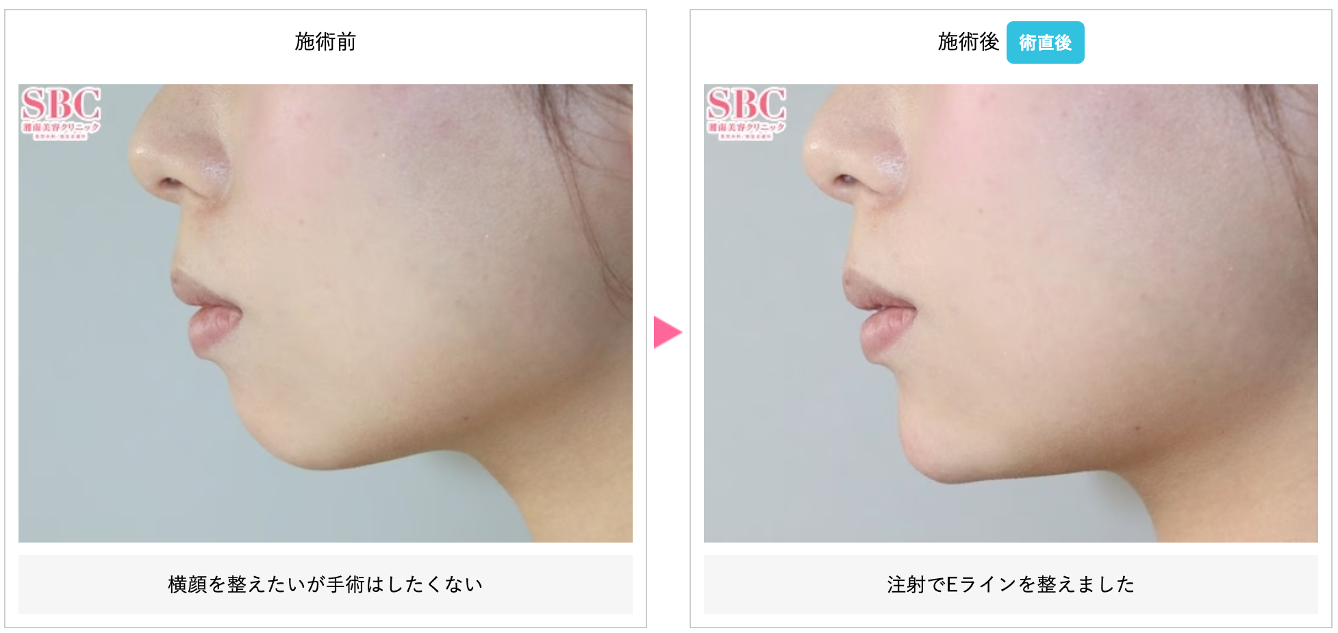 湘南美容クリニックのヒアルロン酸施術であごへ注入した症例写真