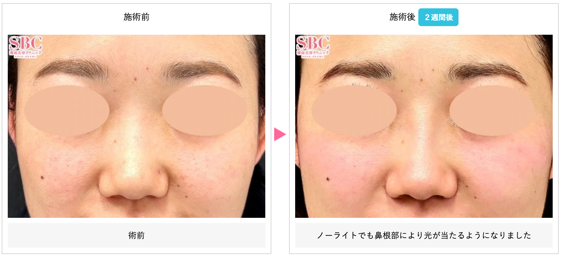 湘南美容クリニックのヒアルロン酸施術で鼻へ注入した症例写真