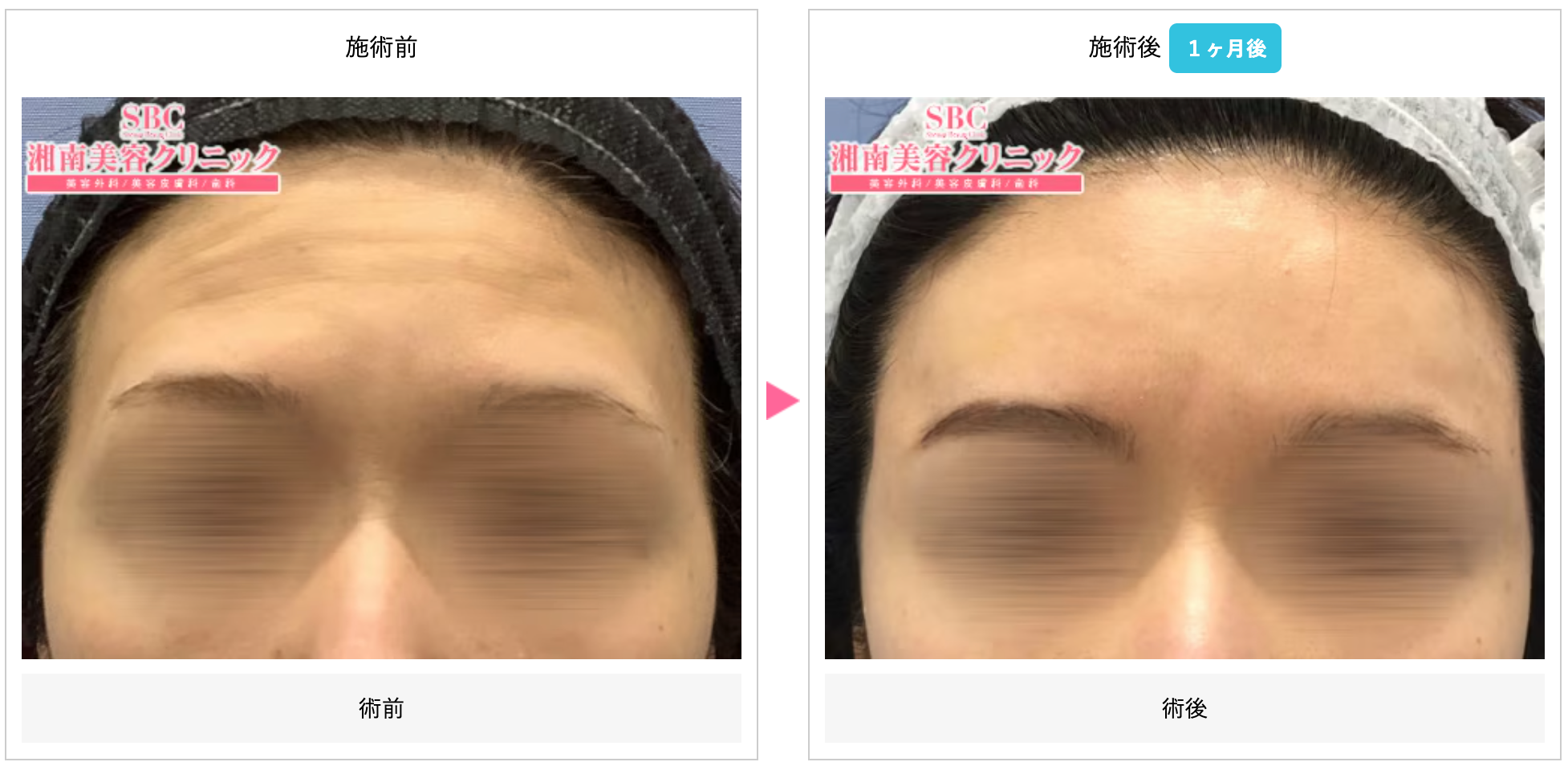 湘南美容クリニックのヒアルロン酸施術でおでこへ注入した症例写真