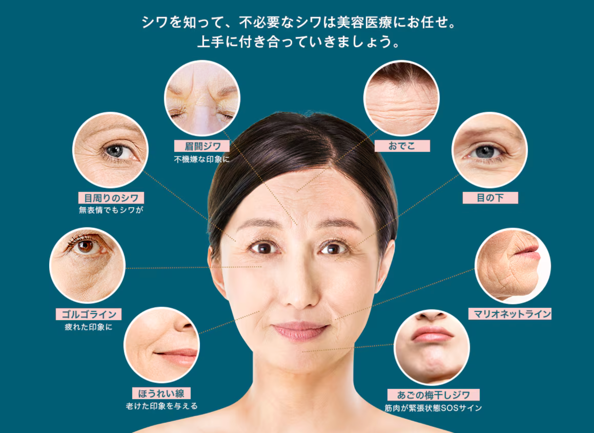 湘南美容クリニックのヒアルロン酸注射LP