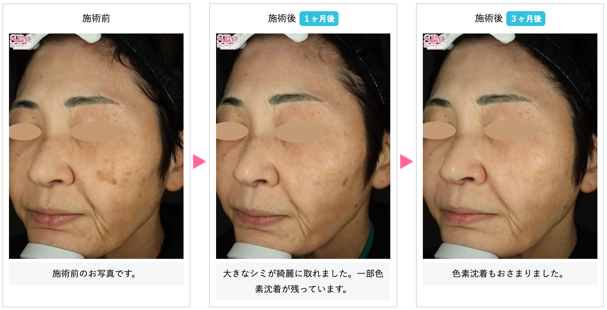 湘南美容クリニックのシミ取り症例