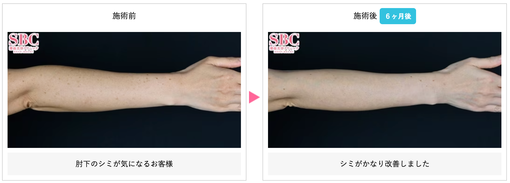 湘南美容クリニックのシミ取り症例