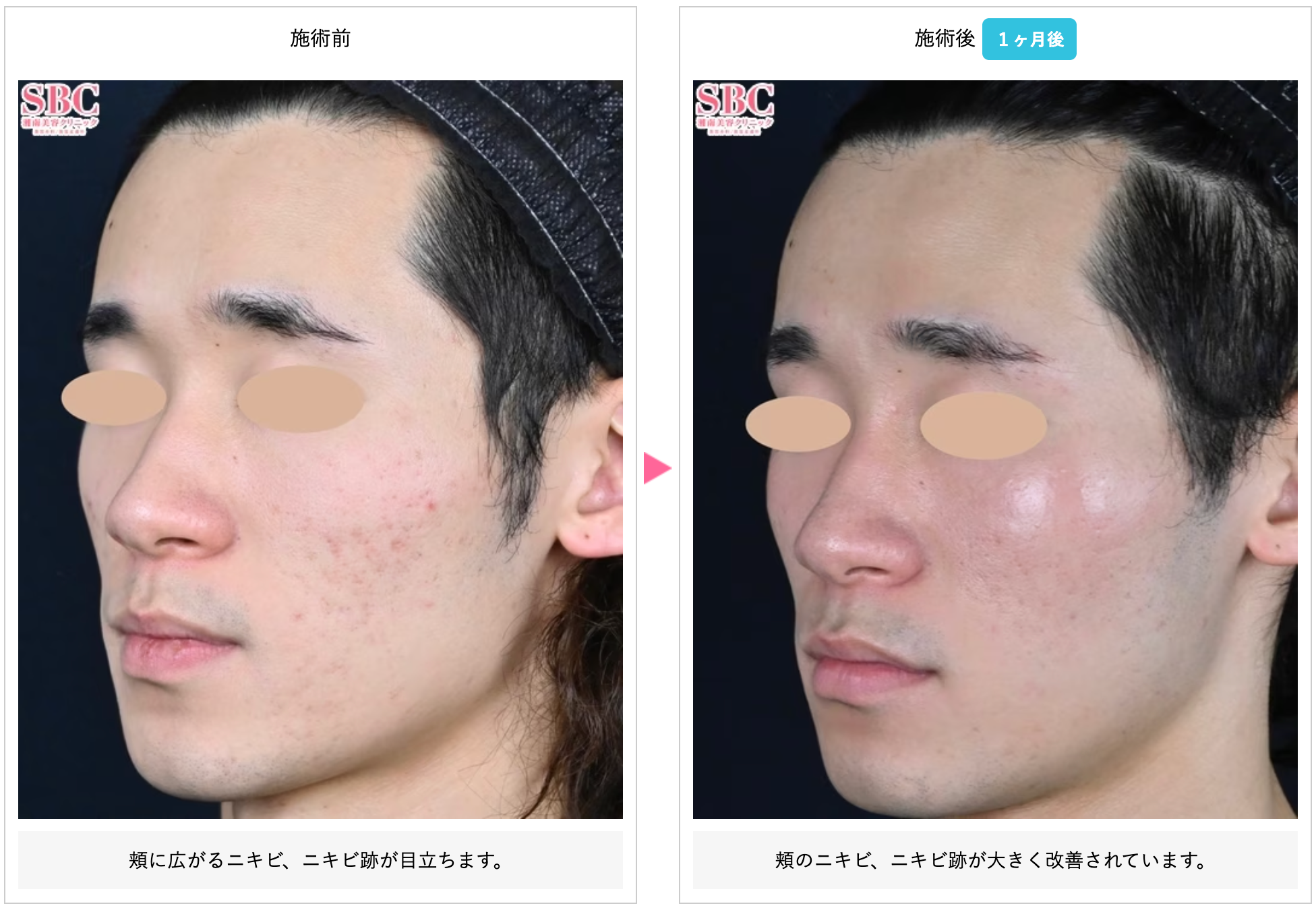 湘南美容クリニックのシルファームXの症例写真